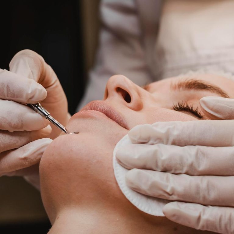 Acne Treatment at Gilmore Wellness Clinic