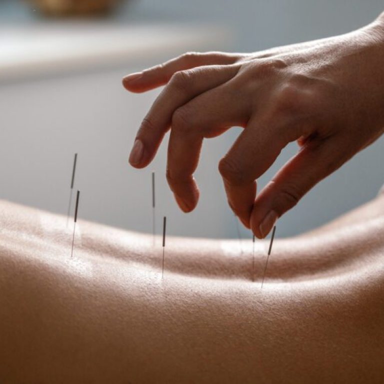 acupuncture